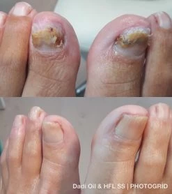 De Nummer 1 Tegen Schimmelnagels! - HFL - Laboratories - Solution Spray - 50ml + Dadi'Oil Nagelriem Olie - 3.75ml - Kalknagel Spray - Schimmelnagel Spray - Nagelriem Olie - Nagelverzorging -Manicure En Pedicure 1065x1200