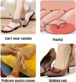 Merkloos Ingegroeide Teennagel Corrector -Manicure En Pedicure 1111x1200