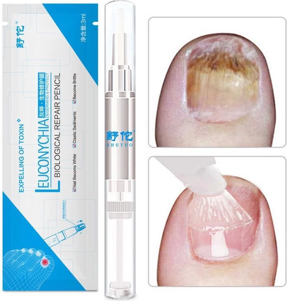 Anti- Kalknagel Behandeling Puur Natuur 1 Anti- Kalknagel Behandeling Puur Natuur