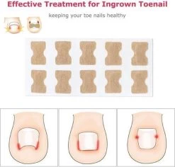 Merkloos Ingegroeide Teennagel Corrector -Manicure En Pedicure 1200x1146