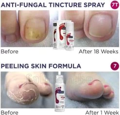Footlogix Toe Nail Tincture Nagelspray -Manicure En Pedicure 1200x1150 1