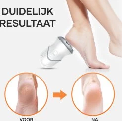 MW® Elektrische Eeltverwijderaar - Voetvijl - Eelt Verwijderaar - Elektrische Vijl - 3 Vijlschijven -Manicure En Pedicure 1200x1191