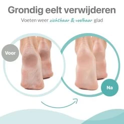 Be Lavish Elektrische Eeltverwijderaar Met Stofzuigsysteem - Voetvijl - Eeltvijl - IPX7 Waterdicht - USB Oplaadbaar - Inc. 3 Opzetstukken & Borstel -Manicure En Pedicure 1200x1200 188