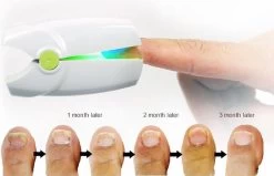 Anti Schimmelnagel Kalknagel Laserapparaat Om Zelf Te Behandelen, Veilig, Effectief, Snel En Pijnloos, Koude Laser Behandeling Voor Thuisgebruik, Voor Tenen En Vingers. Oplaadbaar. -Manicure En Pedicure 1200x774